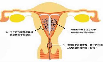 子宫腺肌症最新治疗策略与进展综述